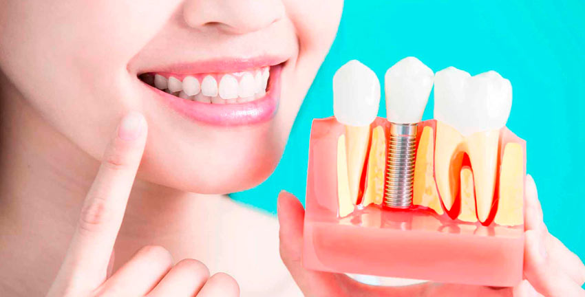 Dental Implants
