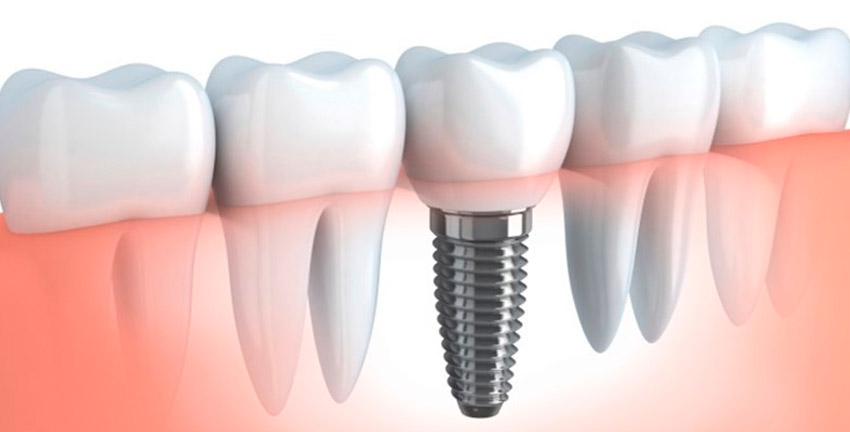 Dental Implants